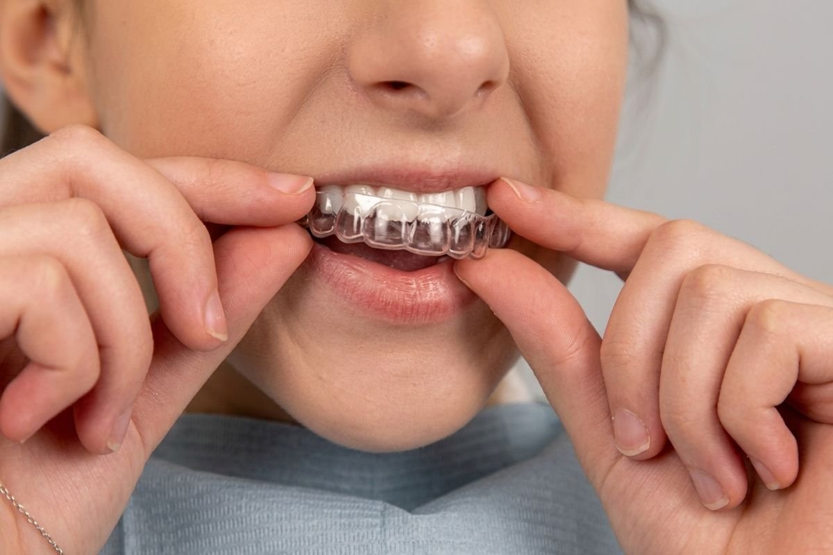 Bruxismo y armonización orofacial en Oralmaax, foto 3